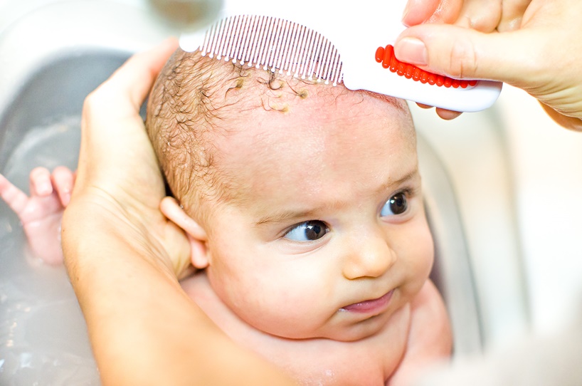 coconut oil for babies cradle cap