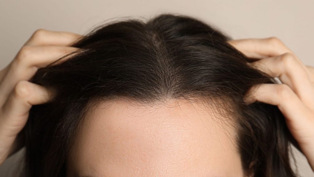 Close-up view of a person's hands parting their dark hair to show a visible scalp, indicating hair thinning or hair loss.