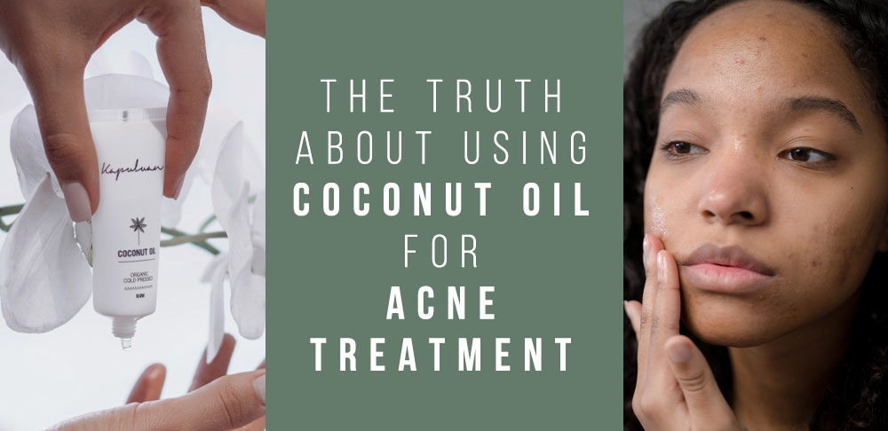 Split image: left side shows a hand holding a coconut oil product; right side features a close-up of a woman examining her face. center has text "the truth about using coconut oil for acne treatment.