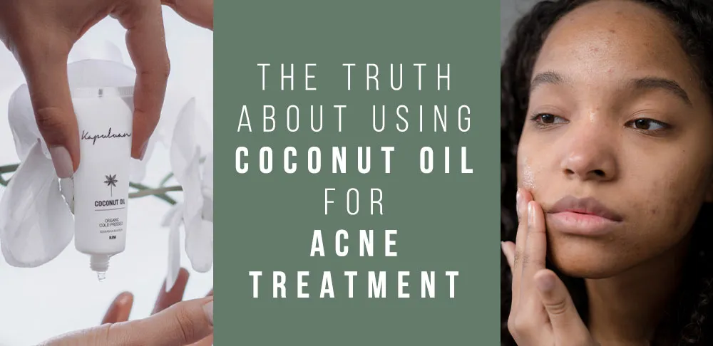 A close-up of a person looking at their acne in the mirror on the right. A hand holding a tube labeled "Coconut Oil" on the left. The center text reads, "The Truth About Using Coconut Oil for Acne Treatment.
